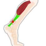 muscle mollet tendon courbature